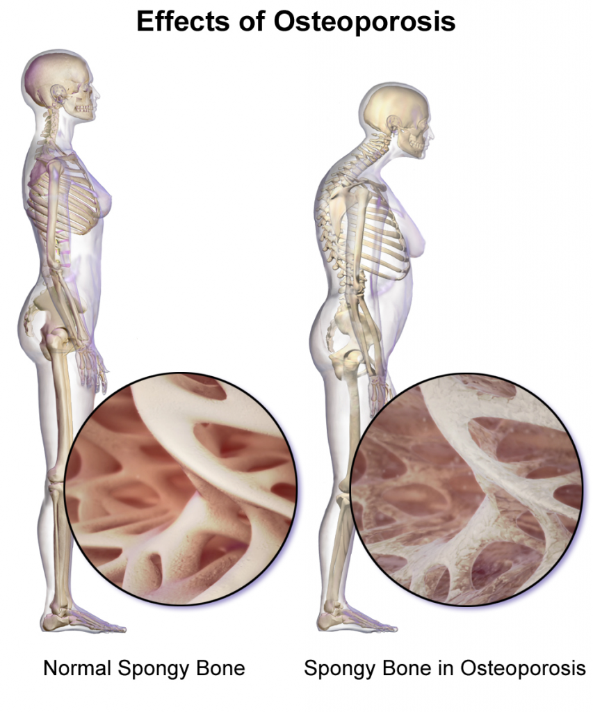 effects of osteoporosis